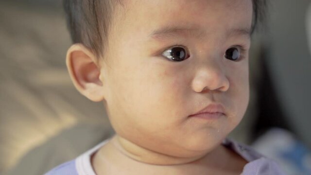 portrait of asian baby with skin rashes from allergies or irritation and itchy