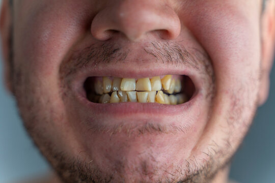 dirty teeth due to heavy smoking cigarette. dirty teeth due to heavy smoking cigarette