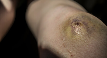 Naklejka premium Large bruise on a person's knee. Wound on the leg close up. Pain concept