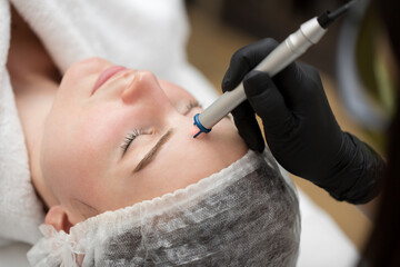 Close-up removal of blood vessels on the face of a diode laser in a cosmetic clinic. Therapist...