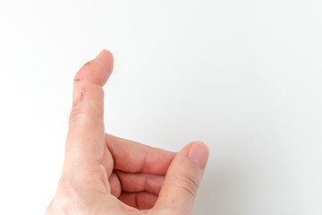 cut index finger with a extensor tendon injury, mallet finger, fingertip bending downwards while...