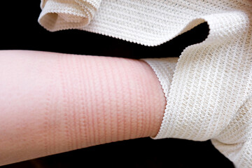 The medical bandage left a mark on the skin. Beige elastic bandage