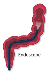 Removing polyps procedure. Flat vector illustration of colorectal cancer screening on white background isolated. Colonoscopy endoscopic examination of the large bowel.