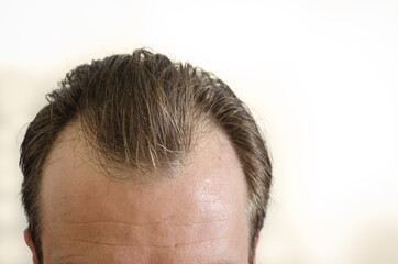 Hair loss men.  Hair care.