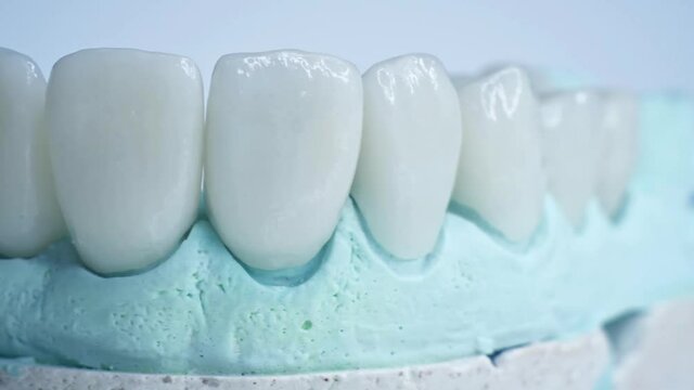 Panoramic close up view of dental implants in jaw with blue background. New white teeth are on a table in lab