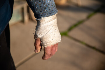 Swollen broken hand of old man in dirty white bandage