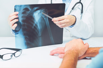 Female doctors hand pointing at x-ray medical imaging with a shoulder condition. Bone health,...