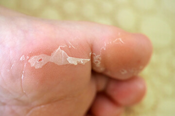 Fototapeta premium Foot peeling or remove dead skin, callus on the feet
