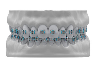 Human jaws with healthy teeth and classic metal braces, front view, isolated, 3d render