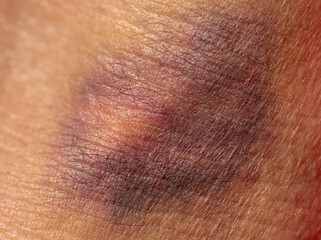 Closeup of purple bruise on someone's skin
