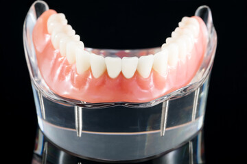 Teeth model showing an implant crown bridge model/ dental demonstration teeth study teach model.