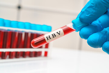 Blood sample   test tube in doctor hand for   hepatitis B virus  HBV test