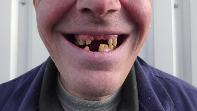 Rotten and fallen teeth of men. Without care, teeth may suffer.