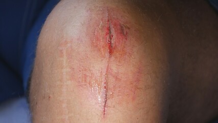 Doctor Cleaning Infected Foot Wound Using Medical Disinfectant and Bandage in Hospital Emergency Room