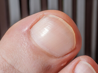 Close-up of a big toe of the right foot. Details of the of the unevenly cut toenail and a small...