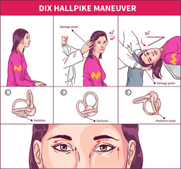 Dix Hallpike Maneuver Vector  illustration