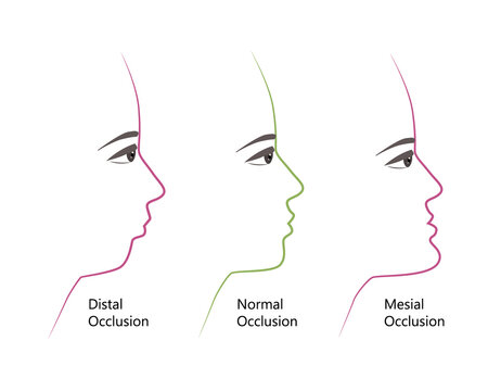 distal, Normal, and Mesial bite profile, vector illustration. Overbite or underbite before and after orthodontic treatment. Human with malocclusion, bite correction by braces concept