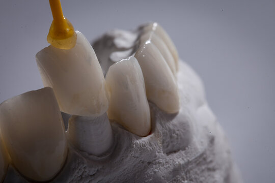 Dental Art, Smile design, Teeht