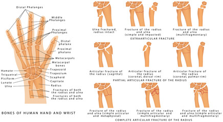 Wrist Fractures. Diagram of wrist have bone fracture. Broken arm bone view show fracture of ulna and radius bone. 