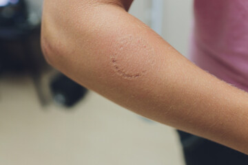 Toddler's bite marks on mothers arm - aggressive toddlers behavior psychology.