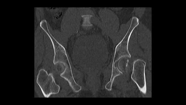 Computed Tomography  of the  pelvis in coronal plane showing left femur neck fracture ( CT Pelvis).Radiology examination