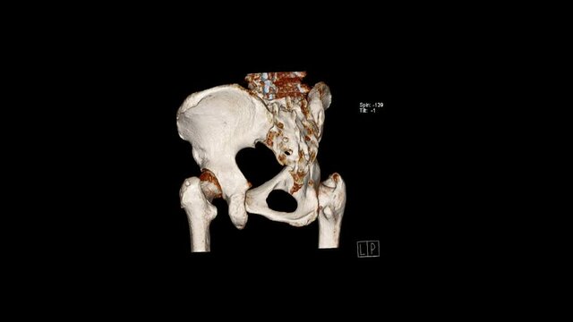  Computed Tomography Volume Rendering examination of the  pelvic bones ( CT VR pelvic bones).Radiology examination.
