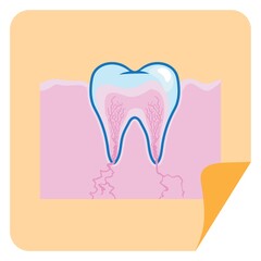 root canal in a tooth