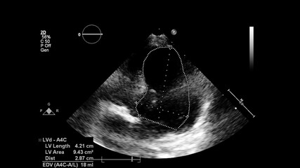 Image of the heart in gray-scale mode during transesophageal ultrasound.