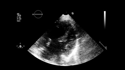 Image of the heart in gray-scale mode during transesophageal ultrasound.