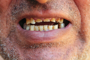 Bad teeth, close up. Smoker with bad teeth.