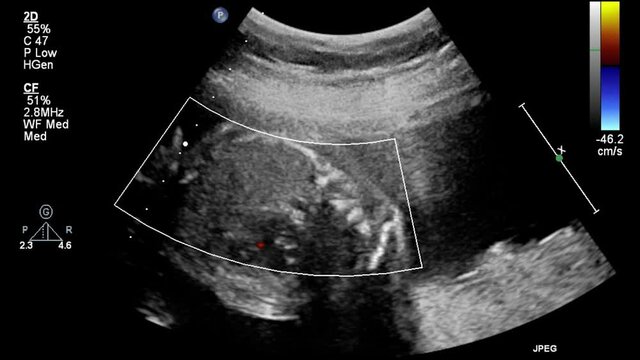 Ultrasound examination of the fetal heart.