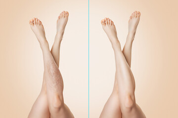 Before and after. Female legs raised up and crossed with each other, with and without varicose...