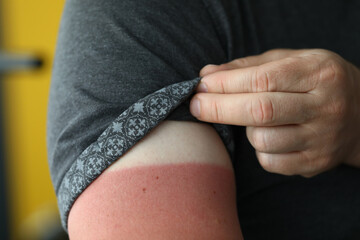 Male hand with a severe sunburn closeup. Sun protection concept