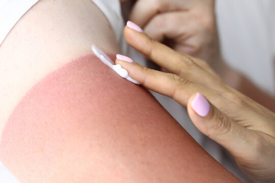 Woman's hand applies cream to burn to treat sunburn. Consequences of sunburn and their treatment concept