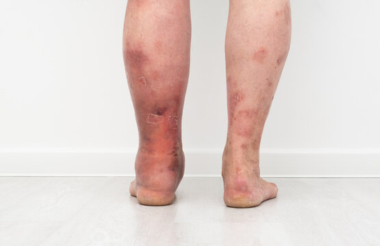 Close up photo of legs with lymphostasis from behind.