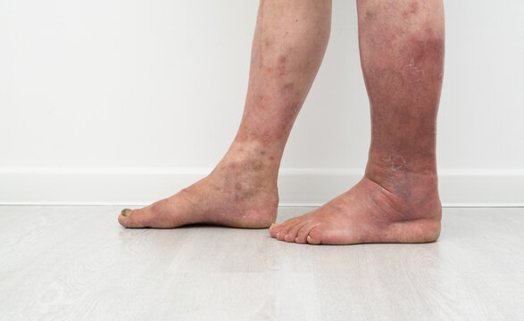  legs with lymphostasis and psoriasis.