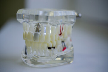 Mock up a sample of the upper and lower jaw in the dentist's office. © gelmold
