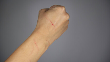 A woman's hand scratched by a cat clenched into a fist on a gray background.