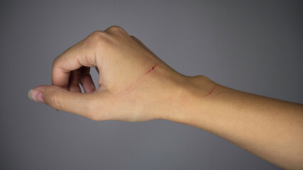 Cat Scratch Disease. A scratched female hand from a cat.