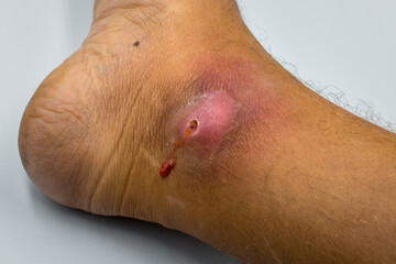 Abscesses form after bacteria. Infected purulent open wound on the man's foot. 