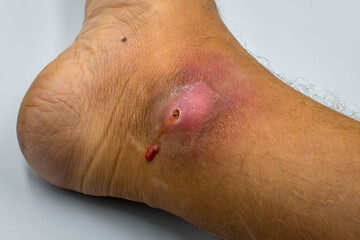 Naklejka premium Abscesses form after bacteria. Infected purulent open wound on the man's foot. 