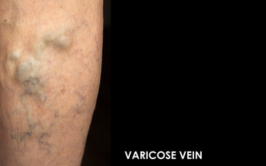 The varicose veins on a legs of old woman on blue