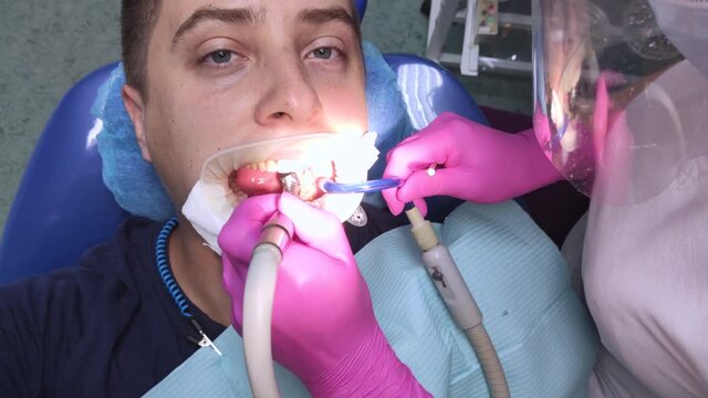 The dentist works with tools with a filling. Caries treatment, restoration of a decayed tooth, professional help, root canal filling. Mouth pain relief concept