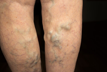 The varicose veins on a legs of old woman