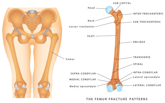 The Femur Fracture Patterns. Different kinds of fractures. Descriptive illustration with examples of fractures of the femur bone on white background.
