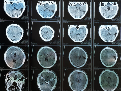 MRI of the braiMRI scan of the human brain after traumatic brain injuryn after trauma. High quality photo