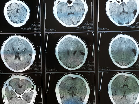 This stock photo shows a magnetic resonance imaging MRI of the brain after traumatic brain injury, showing that the brain is damaged