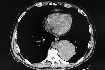 Chest CT Scan shows epidermoid (squamous cell carcinoma) on left lower lobe lung, posterior segment...