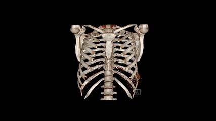 Computed Tomography Volume Rendering examination of the  thoracic cage ( CT VR thoracic cage). 3D rendering