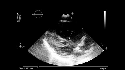 Image of the heart in gray-scale mode during transesophageal ultrasound.